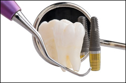 Dental Implants1