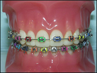 Braces