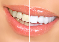 Teeth Whitening, Blog