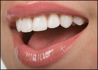 Veneers