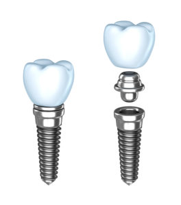 Dental Implant Assembly 264x300, Blog