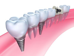 Dental Implants1, Blog