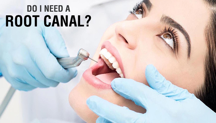 root canal treatment sanjose