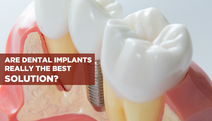 dental implant