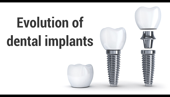 Evolution Dental Implants