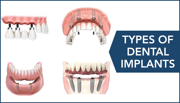 Type Of Implants, Blog