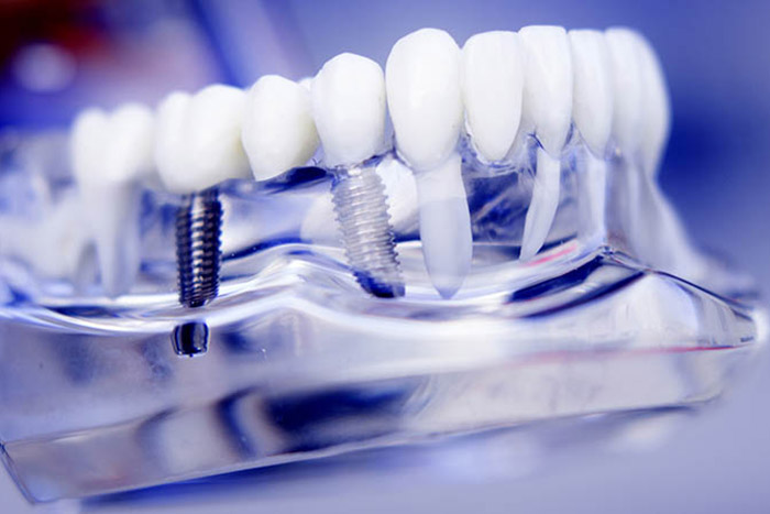 dental implant model op