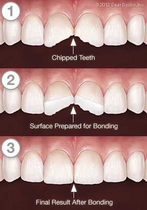 🥇 NYC Teeth Bonding  Upper East Side Cosmetic Dental Bonding